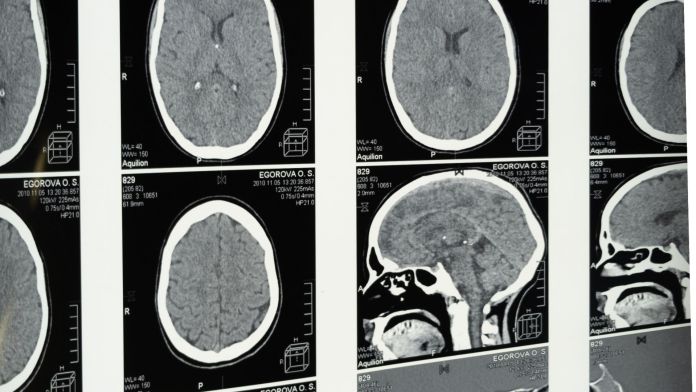 brain scan